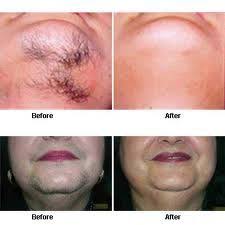 From facial hair removal creams to options specially formulated for sensitive skin, these are the best hair removal creams, according to thousands of customer reviews. Hair Removal Cream Products Hair Removal Chin Hair Removal Hair Removal Permanent