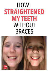 That is how braces work. Pin On Health Wellness