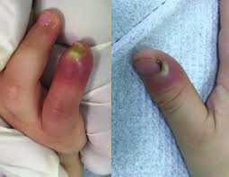 Image result for phlegmon of hand)