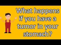 Unlike their deep soft tissue counterparts, most glomus tumors in the stomach are benign. What Happens If You Have A Tumor In Your Stomach Healthy Living Faqs Youtube