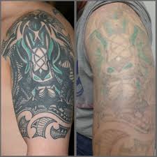 This sub is intended to discuss laser tattoo removal. Peerless Laser Tattoo Removal Before And After Reddit Painless Laser Tattoo Removal