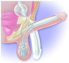 Protese Peniana Inflavel Dr Alessandro Rossol