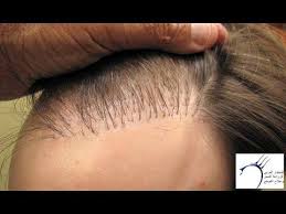 زراعة الشعر زرع الشعر واضراره على الانسان زراعة الشعر في ايران Hair Plugs Behind Ear Tattoo Hair
