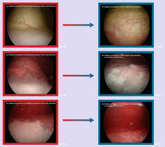 Image result for Recurrent Cystitis