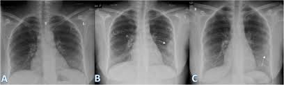 Image result for Chest XRay