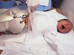 ختان الحلقة بالصور