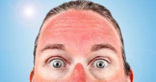 Simpan estrogen di tempat tertutup dalam suhu ruangan dan jangan dibekukan. Kulit Terbakar Sinar Matahari Atasi Dengan 8 Langkah Ini Kawaii Beauty Japan