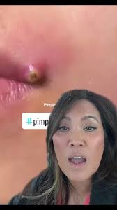 Spoiler alert: they don’t pop it in the video! Never pop HSV cold sores 🚫,  #duet with @pimples_brufoli_