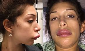 Teen Moms Farrah Abraham in the ER after her lip injections take a bad  turn | Daily Mail Online