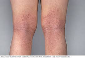 Dermatitis Atopica Eccema Middlesex Health