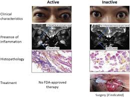 Graves disease thyroid eye disease photos. A New Era In The Treatment Of Thyroid Eye Disease American Journal Of Ophthalmology