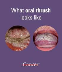Image result for Oral thrush roof of mouth