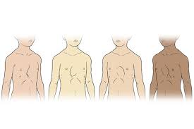 Image result for Pectus Excavatum