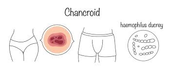 Image result for chancroid