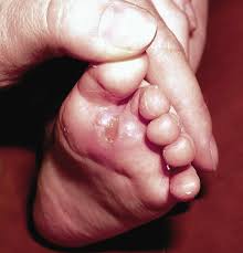 Blisters are small raised areas that are filled with fluid and located in the superficial layer of the skin. When A Newborn Presents With A Skin Condition On Both Feet Podiatry Today