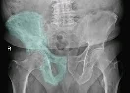 The l4 vertebra demonstrates cortical thickening, thickened trabeculae, and slightly increased size compared to other vertebrae in keeping with vertebral paget disease. Paget Disease Of Bone Amboss