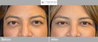 We did not find results for: Graves Disease Thyroid Eye Disease Orbital Decompression Bulgy Eye Surgery Photos Mehryar Ray Taban Md