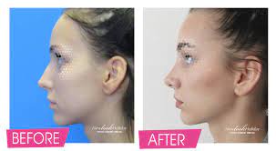 Please look carefully at the postoperative images. Rhinoplasty Surgery Find Out Rhinoplasty Cost