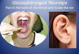 Pin On Glossopharyngeal Neuralgia Gpn