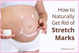 Diy natural stretch mark removal creams & scrub recipes. How To Get Rid Of Stretch Marks Naturally A Diy Stretch Mark Cream