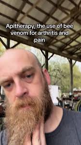 Bee Venom Therapy for Arthritis and Pain Relief