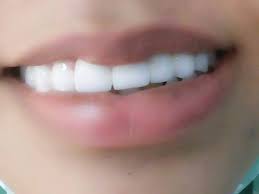 Smile Stardom Dental Clinic الدكتور احمد القطاع Posts Facebook