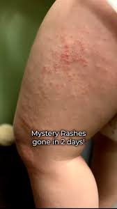 Image result for dermatitis contacta children