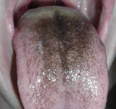 Image result for black tongue symptoms