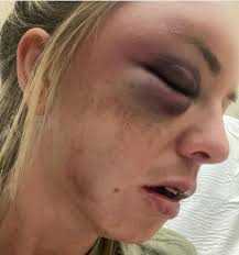 A Jeeper and Mother of 3 @brittanykmoore needs our help y'all! She was a  victim of domestic violence, she has a broken jaw, mouth wired shut and so  many more injuries both