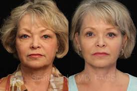 Facelift Surgeon in Boca Raton, FL