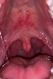 Image result for Canker sores symptoms roof of the mouth