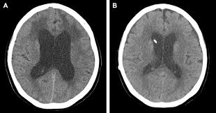 Radiological Findings Before And After Vp Shunt Placement Notes A Download Scientific Diagram