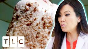 @drpimplepopper for 24/7 pops @drsandralee for my work, my life, my pops facebook: I Ve Never Seen Quite An Extensive Case As This Dr Pimple Popper Before The Pop Youtube