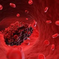 A pulmonary embolism often happens when part of the blood clot dislodges itself from your leg and travels up to your lungs, causing a blockage. Blood Clots Five Reasons They May Happen