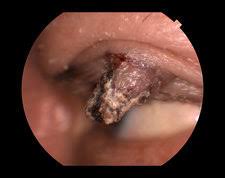 Image result for cornu cutaneum)