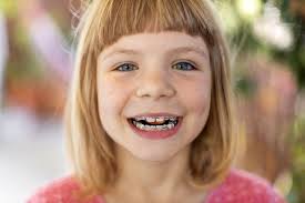 Sonderleistungen müssen immer selbst die dauer der zahnregulierung hängt vom grad und von der art der fehlstellung, vom alter des. Zahnzusatzversicherung Fur Zahnspange Nachtraglich Versichern