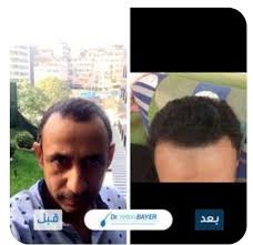 أفضل مركز زراعة شعر في تركيا Yetkin Bayer Clinic Incoming Call Screenshot Doctor Incoming Call