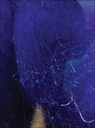 But trust me, pubic hair does eventually take on a grey scattering and then eventually becomes salt and pepper and the. Long Term Pubic Dermatitis Diagnosed As White Piedra Mdedge Dermatology