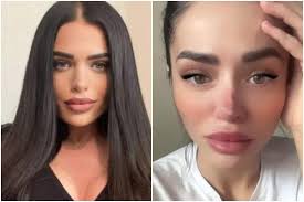 Facetouchup is fast, free, and fun. Reality Star Left With Rotting Nose After Botched Plastic Surgery Begs Fans For Donations See Pics