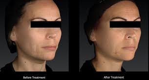 Full‐face effects of temporal volumizing and temporal lifting techniques