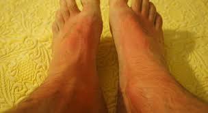 Signs and symptoms of squamous cell carcinoma of the skin include: Find Out The Top Skin Cancer Causes Laser Lipo And Veins