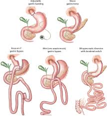 Use liquid or powdered protein supplements to meet daily protein intake goals. Prevention And Treatment Of Nutritional Complications After Bariatric Surgery The Lancet Gastroenterology Hepatology