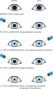 marcus gunn pupil an overview sciencedirect topics