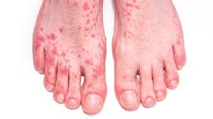 Image result for skin rash acute hiv infection