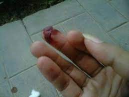 Akibatnya, tangannya terluka dan bercucuran darah. Selalu Ada Makna Dari Setiap Perkara Berawal Dari Jari Yang Tak Lagi Sempurna Kompasiana Com