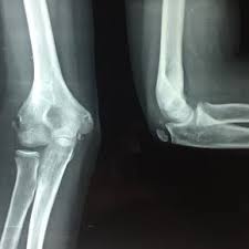 A fracture of the medial epicondyle of the elbow that is the third most common fracture seen in children and is usually seen in boys between the age of 9 and 14. Pdf Medial Epicondyle Fractures In Children A Study Of Functional Outcome Of Surgical Fixation