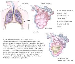 Copd aktuell (copd verstehen, copd behandeln, mit copd leben, service, copd erkennen. Chronische Atmnot Chronische Dyspnoe Eesom Gesundheitsportal