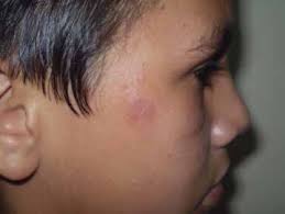 Programa Nacional de Control de Lepra