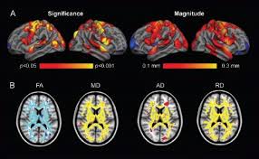 On The Trail Of New Huntington S Disease Treatment Options