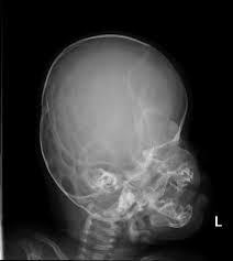 Prominence of convolutional markings seen throughout the skull vault. Epos Trade